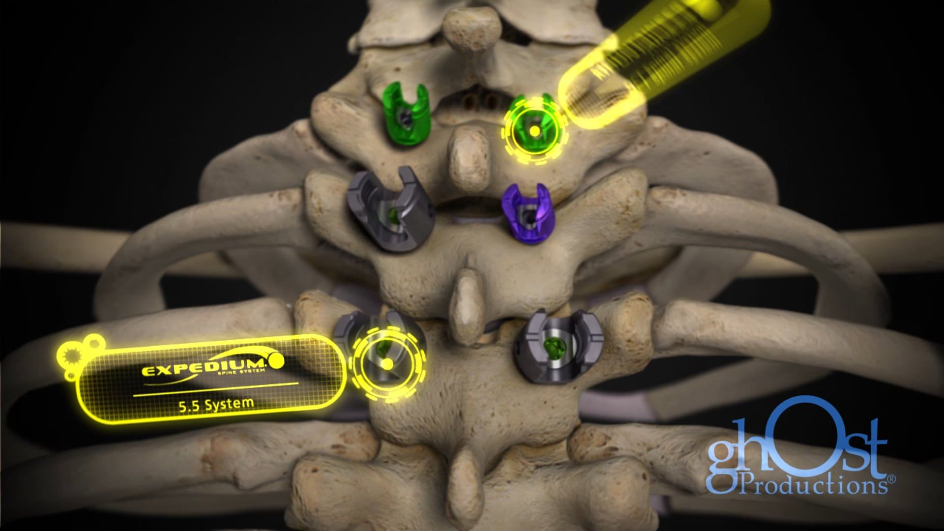 Ghost Medical Presents: Depuy Cervical Fixation Animation