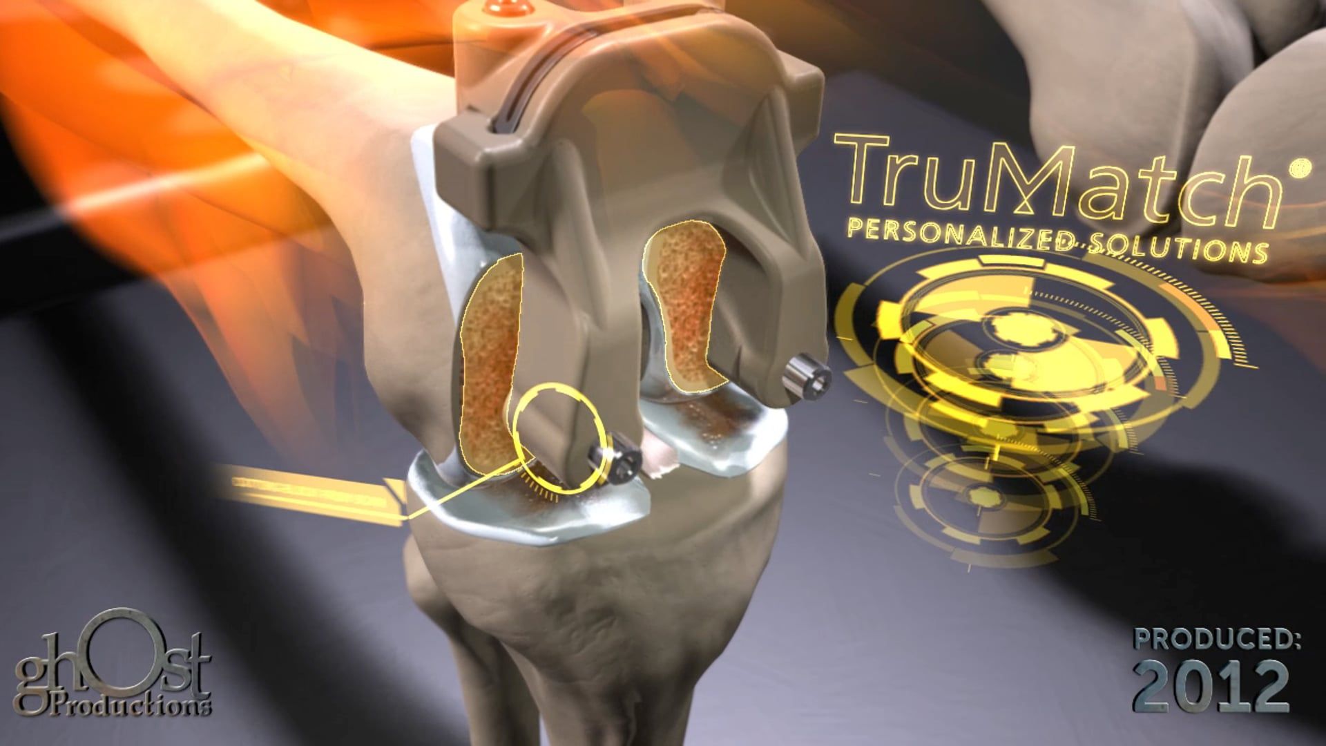 TruMatch Personalized Solutions, Ghost Productions, total knee replacement system, process overview, unique features, benefits, personalized solutions, knee replacement surgery, accurate procedure, efficient procedure, advancements in orthopedic medicine.