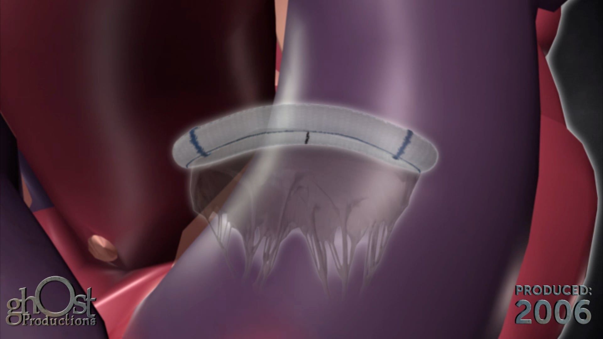Ghost Productions, medical animation, St Jude Medical, Saddle Ring device, heart device, mitral valve annulus, cardiology, medical professionals, patients, groundbreaking device, visually stunning animation, medically accurate depiction, heart function, invaluable tool, educate and inform, latest advancements, heart health.