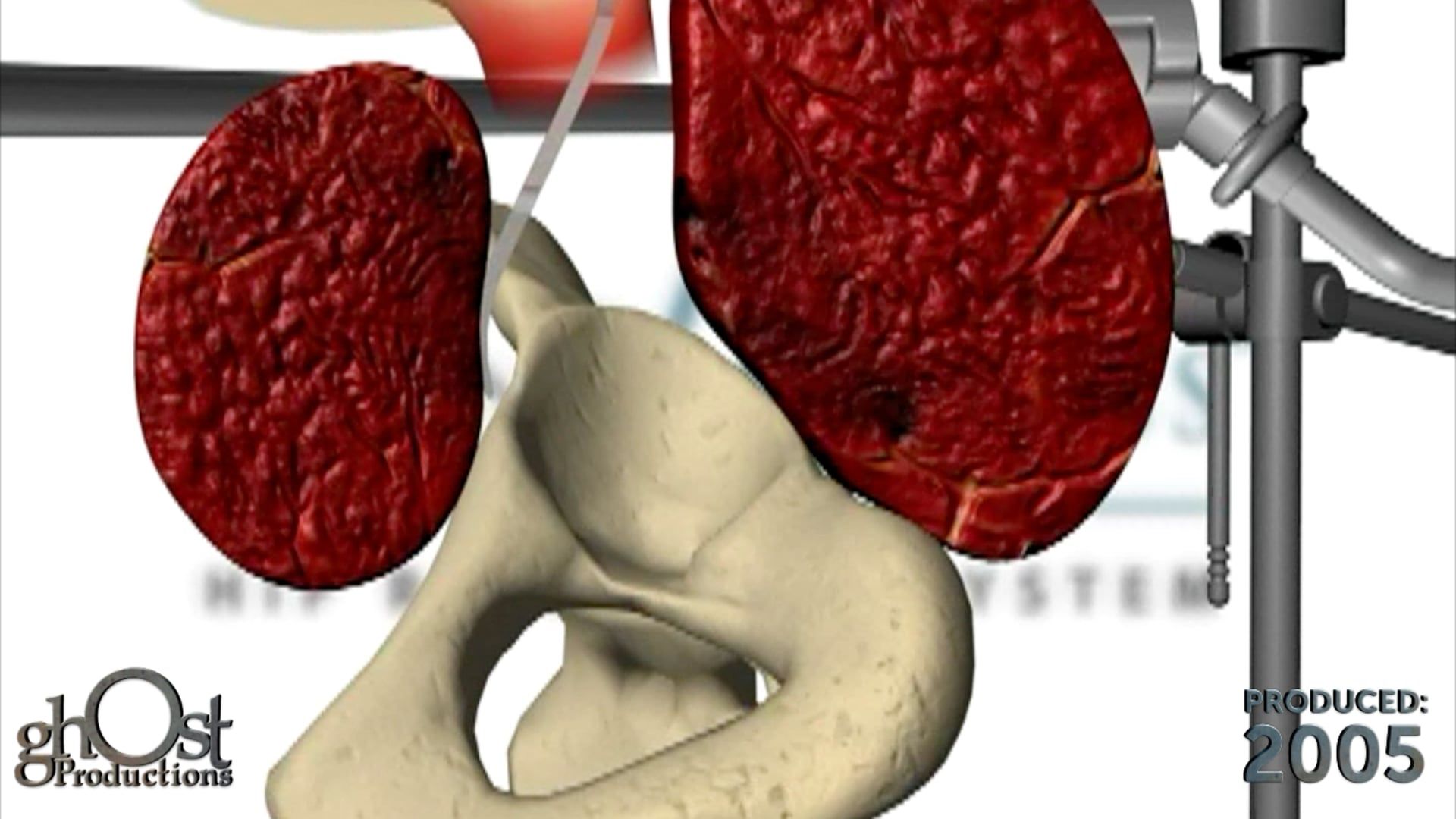 Revolutionizing Surgery with OmniTract - A Ghost Medical Animation