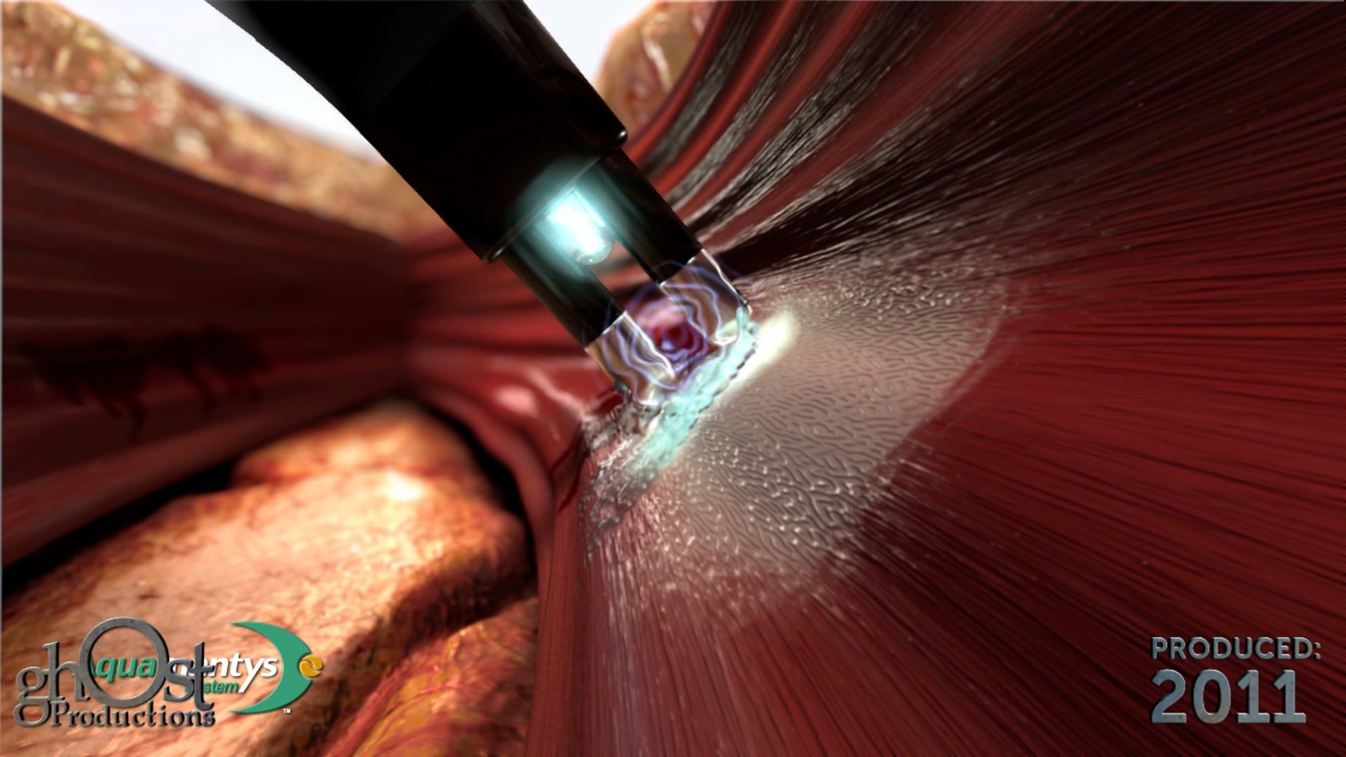 Salient Surgical, Aquamantys system, bipolar sealer, radiofrequency energy, saline, hemostatic sealing, soft tissue, bone, Ghost Productions, medical animation company, informative, visually stunning, advanced technology, benefits, game-changer, surgical medicine, precise, efficient hemostasis, must-have, surgical team, improve patient outcomes, latest advancements, surgical technology.