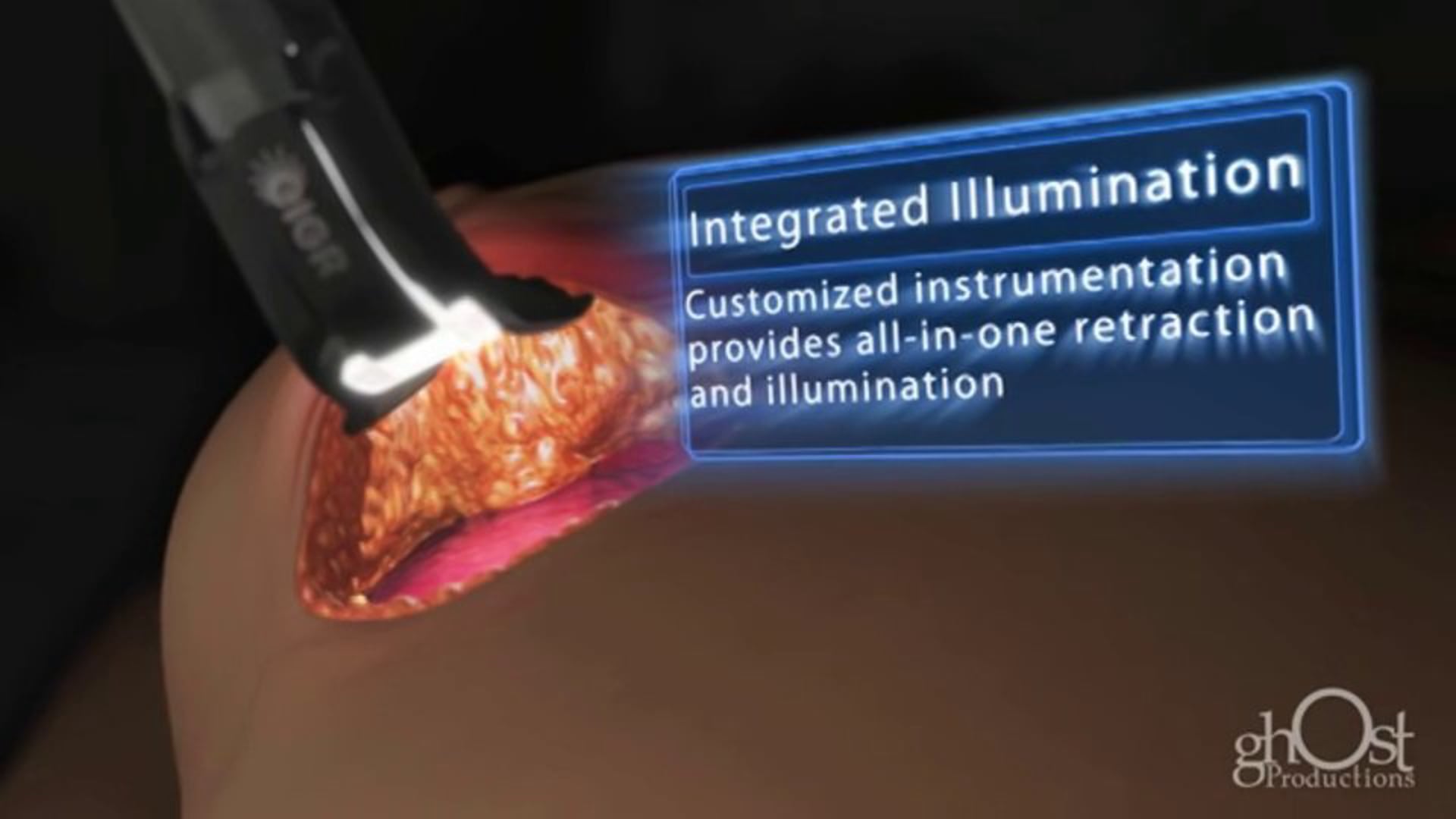 Ghost Medical - Invuity - Eigr Marketing Reel