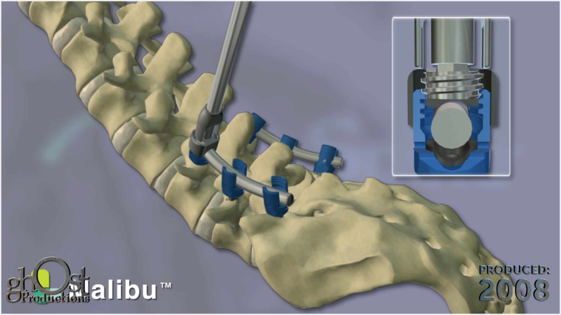 SeaSpine, Malibu system, pedicle screw system, posterior thoracolumbar, sacral fusion, screws, hooks, cross bars, pathologies, Ghost Productions, animation, medically accurate, features, functionality, medical professionals, understanding, potential applications, orthopedic medicine, essential resource, treatment, spinal pathologies.