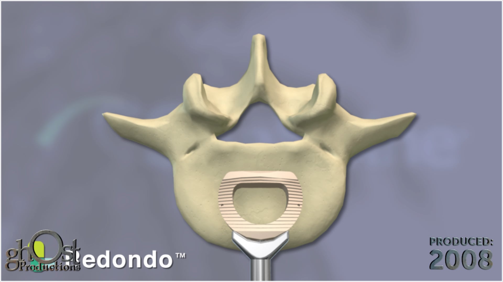 SeaSpine, Redondo system, anterior lumbar interbody system, Ghost Productions, innovative system, footprints, lordotic options, unique anatomies, individual patients, advanced features, revolutionize, spinal surgery, latest developments, innovative products.