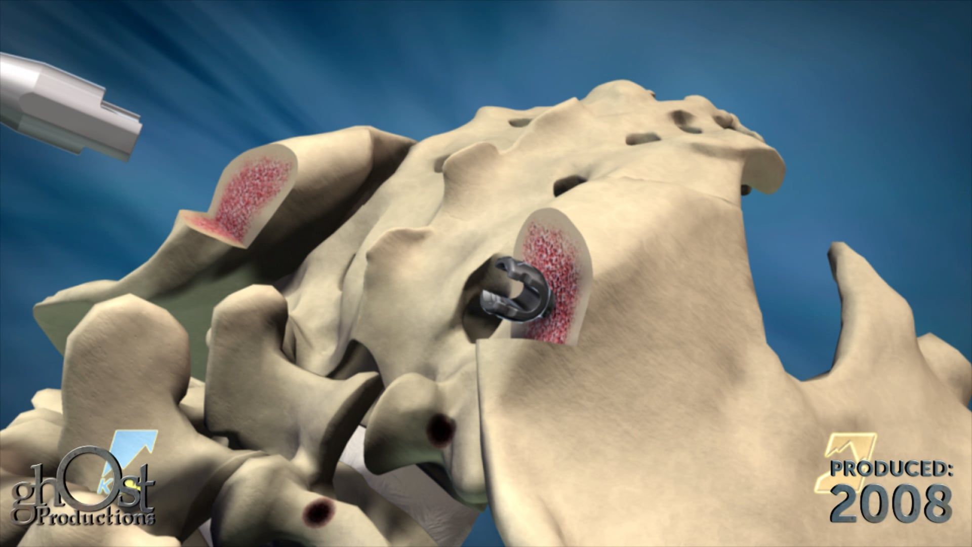 K2M, Ghost Productions, medical device company, Range Complex Spine Technology, thoracolumbar device, spinal pathologies, Denali screw, Mesa screw, healthcare professionals, cutting-edge spinal technology, informative animation, medically accurate video.