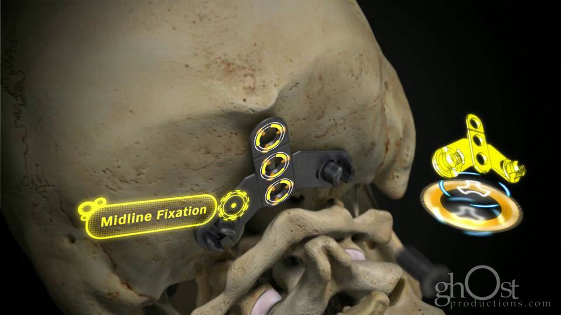 Ghost Productions showcases DePuy's cervical products in a character animation depicting a trauma event on a soccer pitch and a surgical portion.
