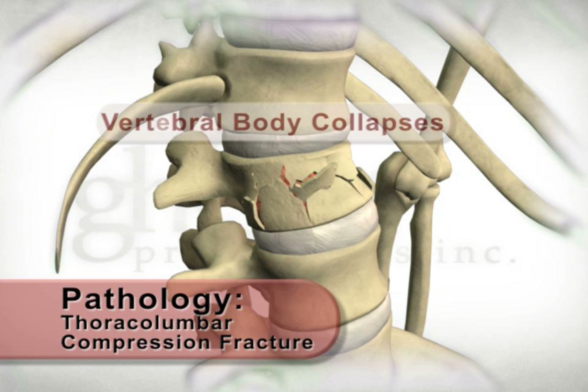 medical animation, trauma on the spine, compression fracture, stress on the spine, collapse of vertebral body, educational information, medical professionals, orthopedics, trauma medicine, Ghost Productions, medical visualization, medical expertise, freely distributed, .edu websites, .org websites, active link.