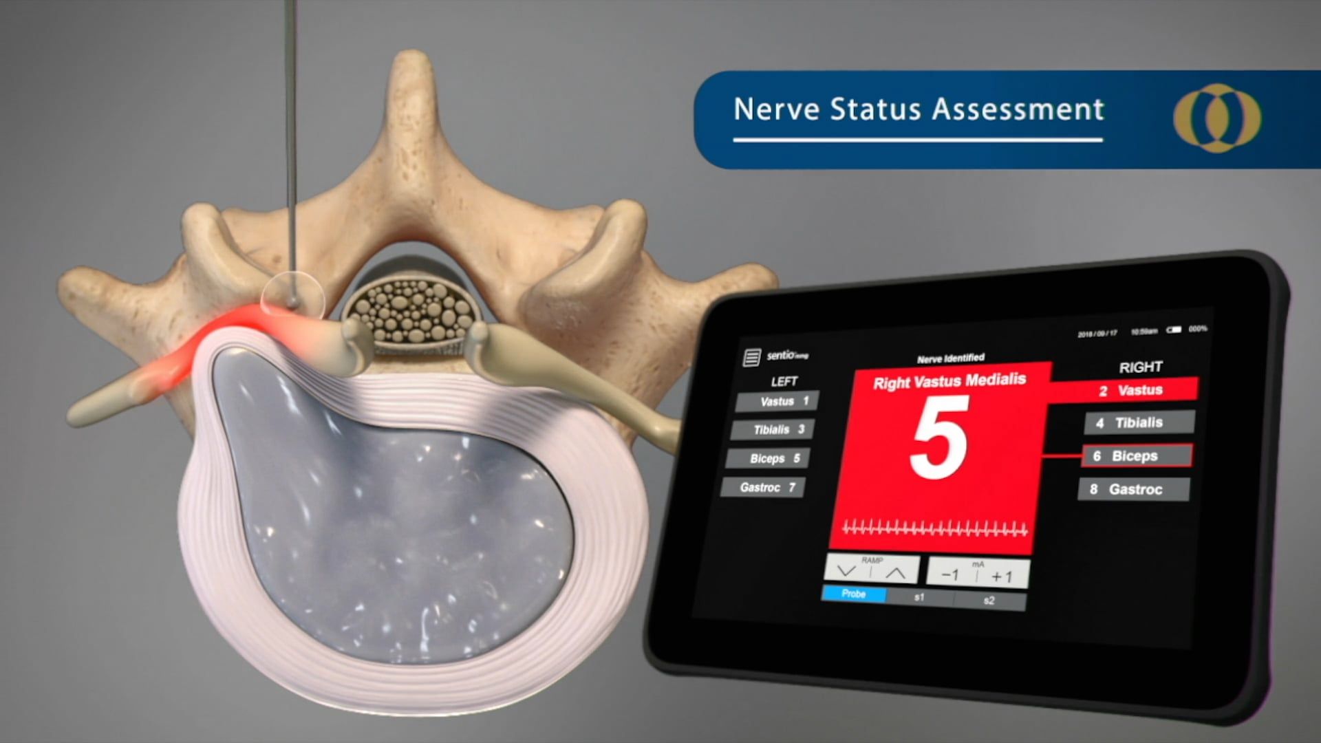 Ghost Medical Presents: DePuy Synthes Sentio Animation