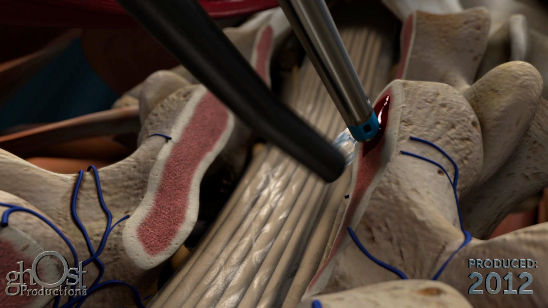 Ghost Medical presents: Aquamantys Spine Animation