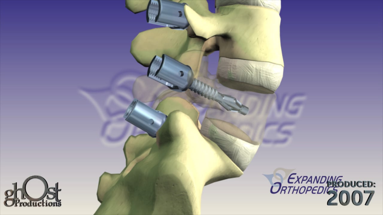 Expanding Orthopedics, EPPS device, posterior lumbar spinal fixation system, stability in the spine, pathologies, orthopedics, animation, Ghost Productions, medical accuracy, function, benefits, medical professionals, patients, spinal issues, essential resource, potential impact, orthopedic medicine.