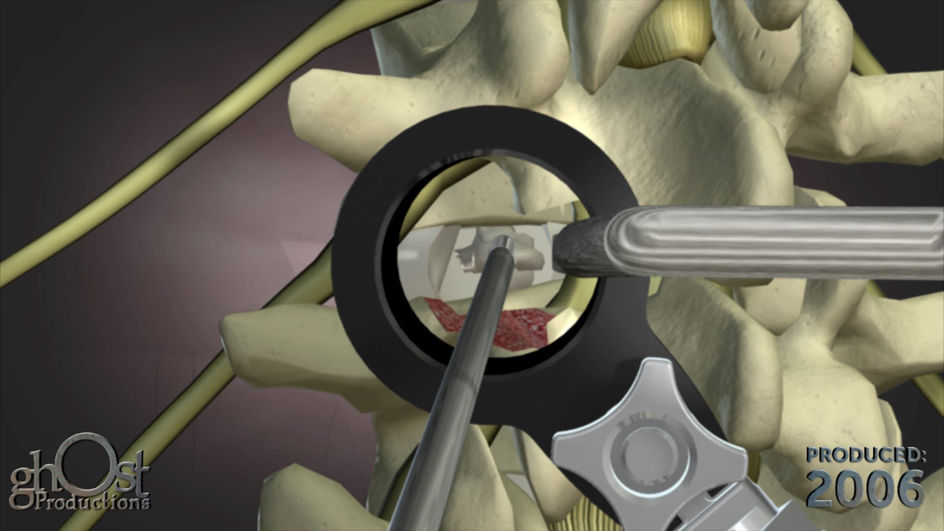 surgical technique animation, Abbott Spine, Traxis device, Ghost Productions, Traxis TLIF, less invasive implantation, medical professional, patient, upcoming procedure, valuable insights, high-quality medical animations, videos.