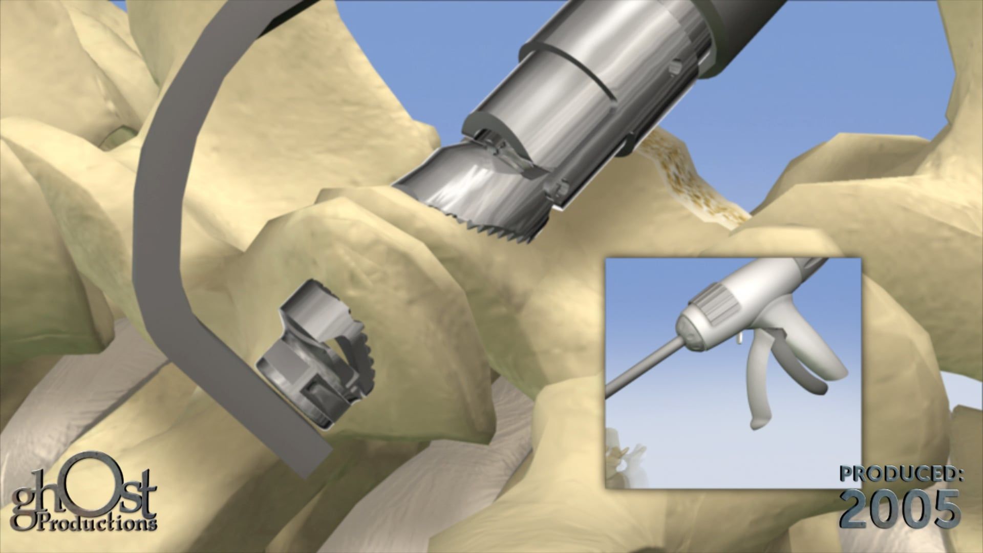 US Spine, Ghost Productions, informative animation, facet fixation technique, minimally invasive procedure, stabilize facet joint, chronic back pain relief, medically accurate depiction, key steps, benefits, resource for patients, minimally invasive spine surgery, latest advancements, spine medicine.