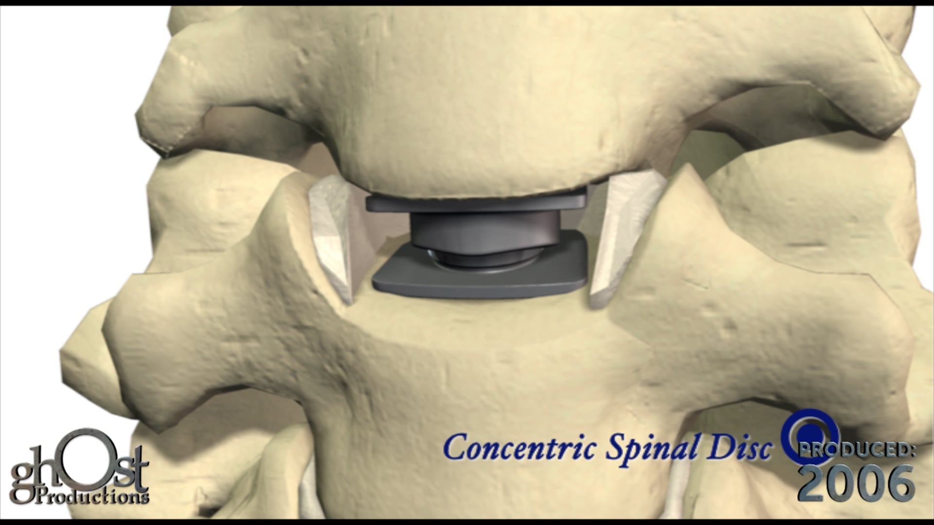 Hammill, medical device company, Ghost Productions, animation, Concentric spinal disc implant, degenerated discs, arthroplasty procedure, orthopedic medicine, healthcare professionals, patients, motion preservation, innovative product, medically accurate depiction, benefits.