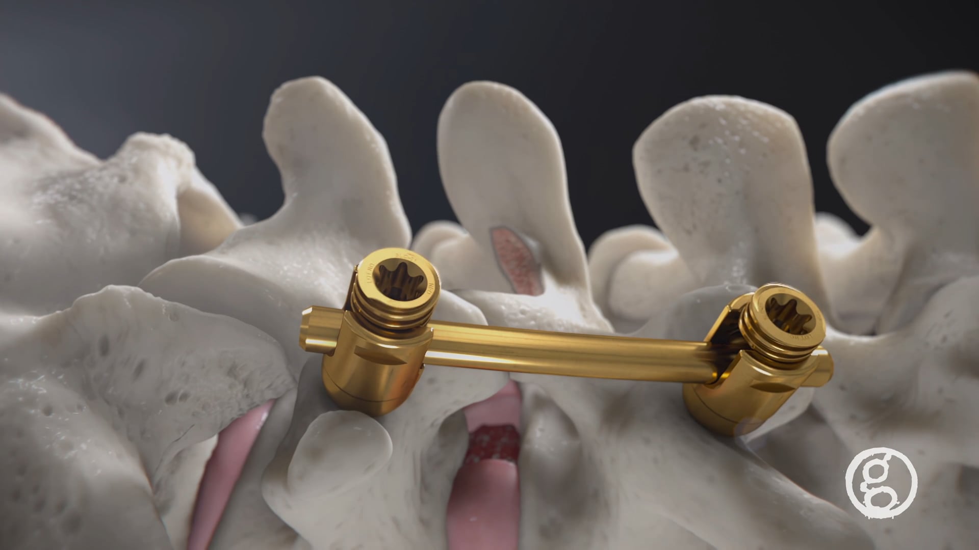 Modera Pedicle Screw System, New Era Orthopaedics, LLC, thoracolumbar spine stabilization, pedicle screws, straight rods, pre-lordosed rods, cannulated screws, non-cannulated screws, intra-operative versatility, medical animation, virtual reality, Ghost Productions, surgical VR developer, medical device, assembly, diameter, lengths, intra-operative, versatility.