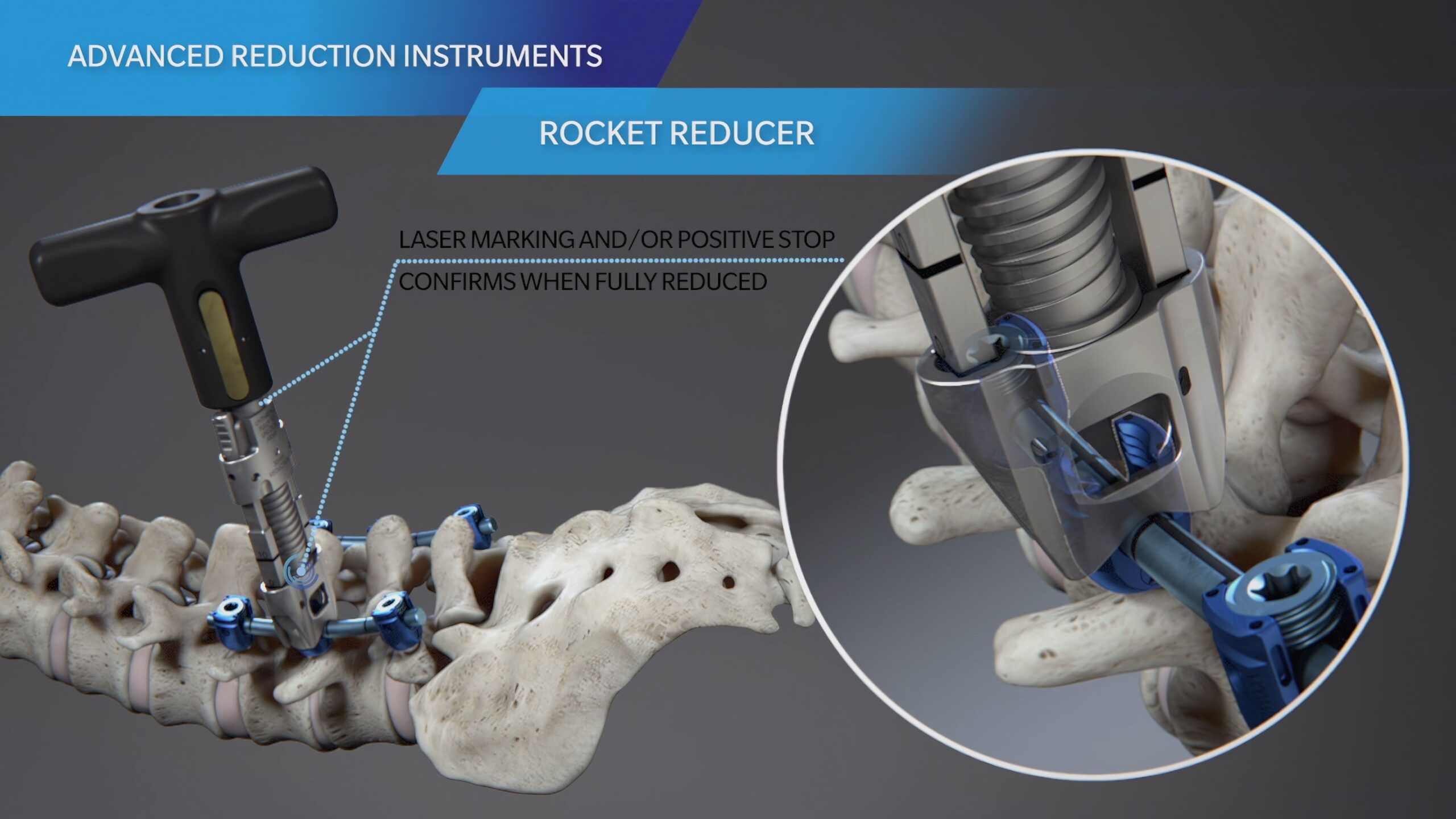 Ghost Medical - Zimmer Biomet Vital™ Spinal Fixation System for Degenerative Conditions