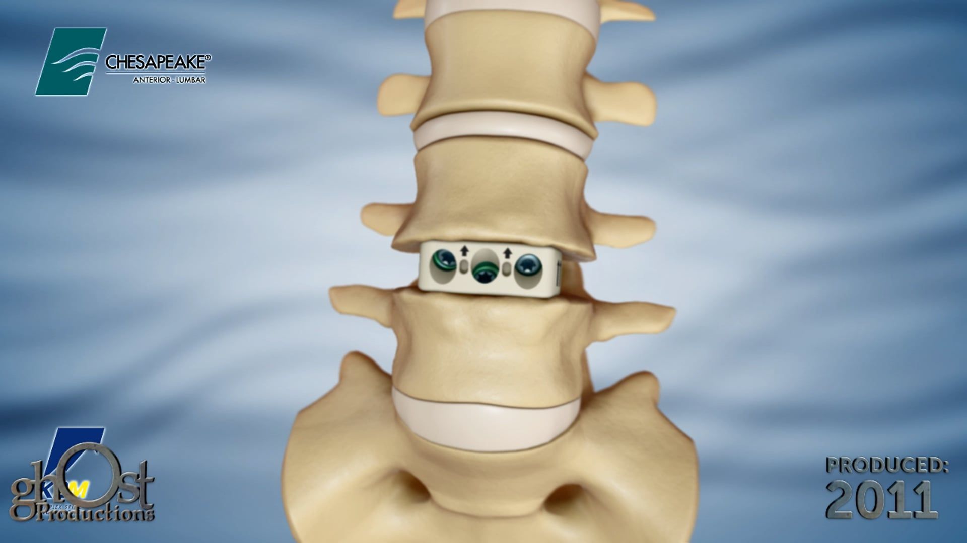 Ghost Medical Presents: K2M Chesapeake - A Revolutionary Spinal Implant Solution