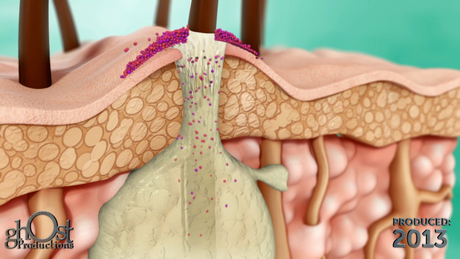 Teen Acne Full Length Edit - Ghost Medical