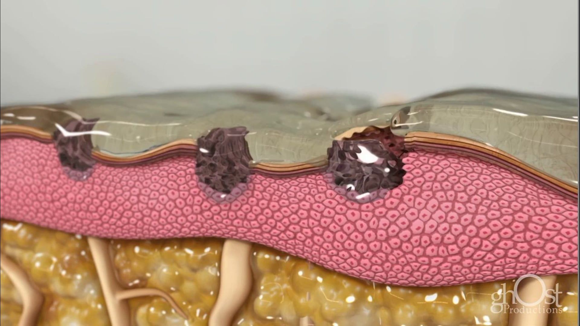 Ghost Medical Presents: Solta - Laser Skin Therapy