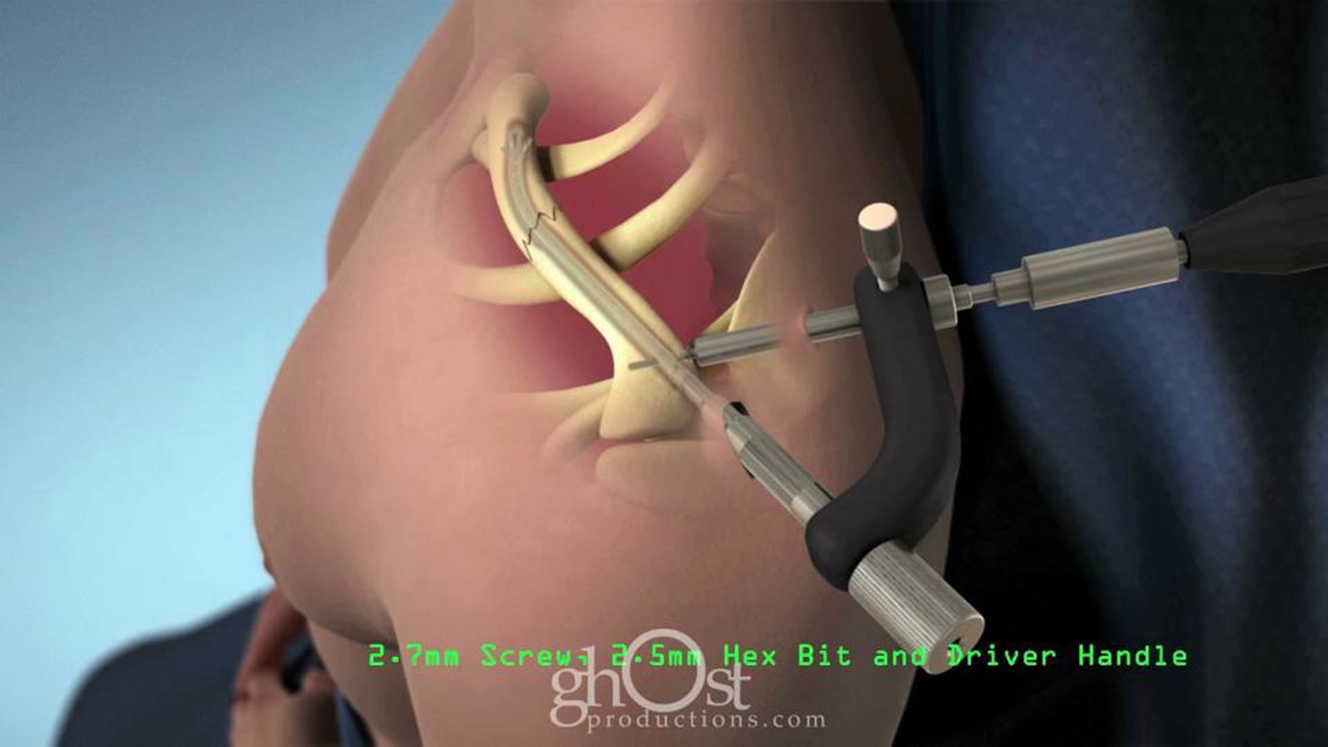 Sonoma Orthopedics Products, Ghost Productions, surgical technique animation, CRx Product, orthopedic surgery, medical device, surgical outcomes, healthcare professionals, patients, key features, benefits, detailed explanations, high-quality visuals, search engine results, information, medical devices.