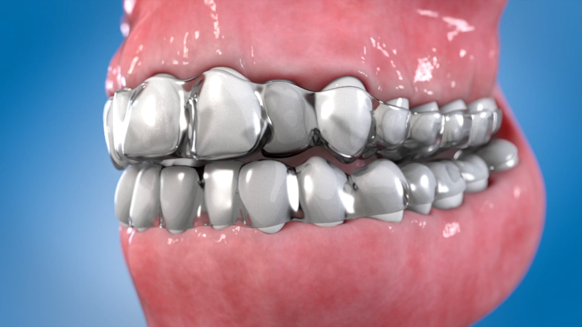 ClearAligners - Dental | Video