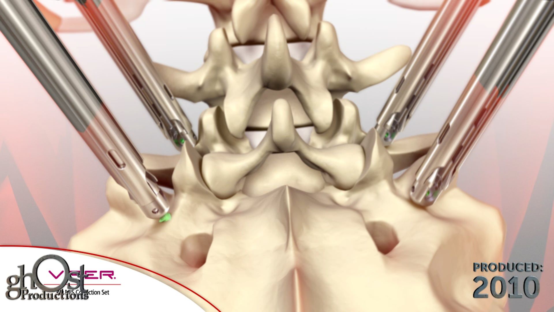 Depuy, Viper 3D, minimally invasive tool, surgeons, thoracolumbar spine, Ghost Productions, animation, stability, L5 vertebra, sacrum, spinal surgery, precise treatment, effective treatment, spinal conditions, medical professionals, patients.