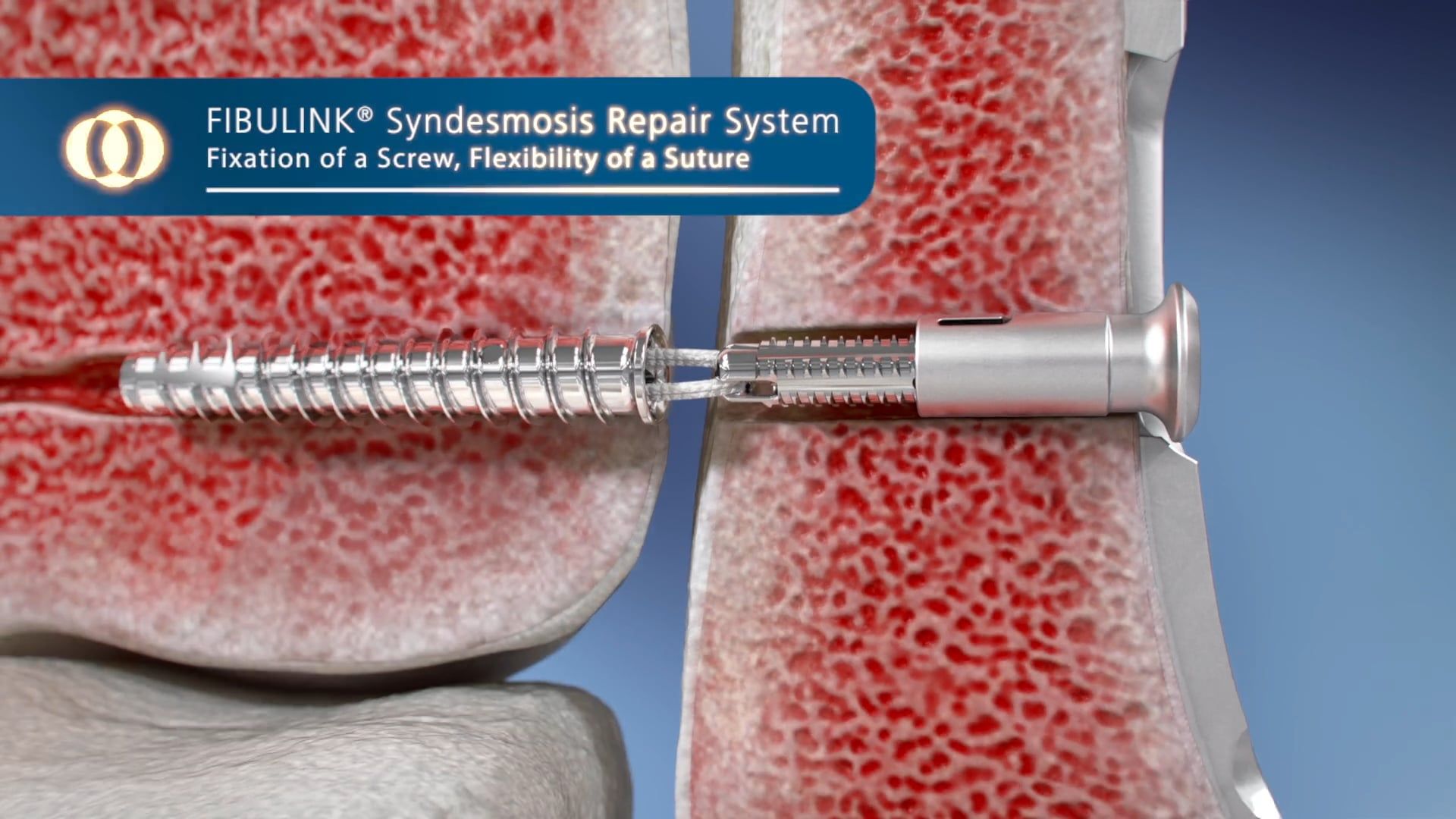 Ghost Productions DePuy FIBULINK® Syndesmosis Repair System | Video