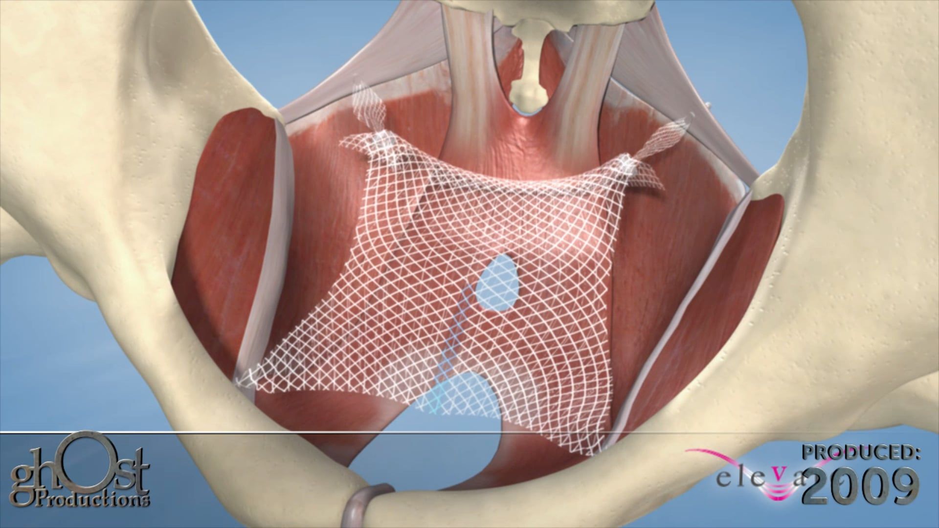 Introducing ElevateAP by Ghost Medical: Advanced Solution for Pelvic Organ Prolapse