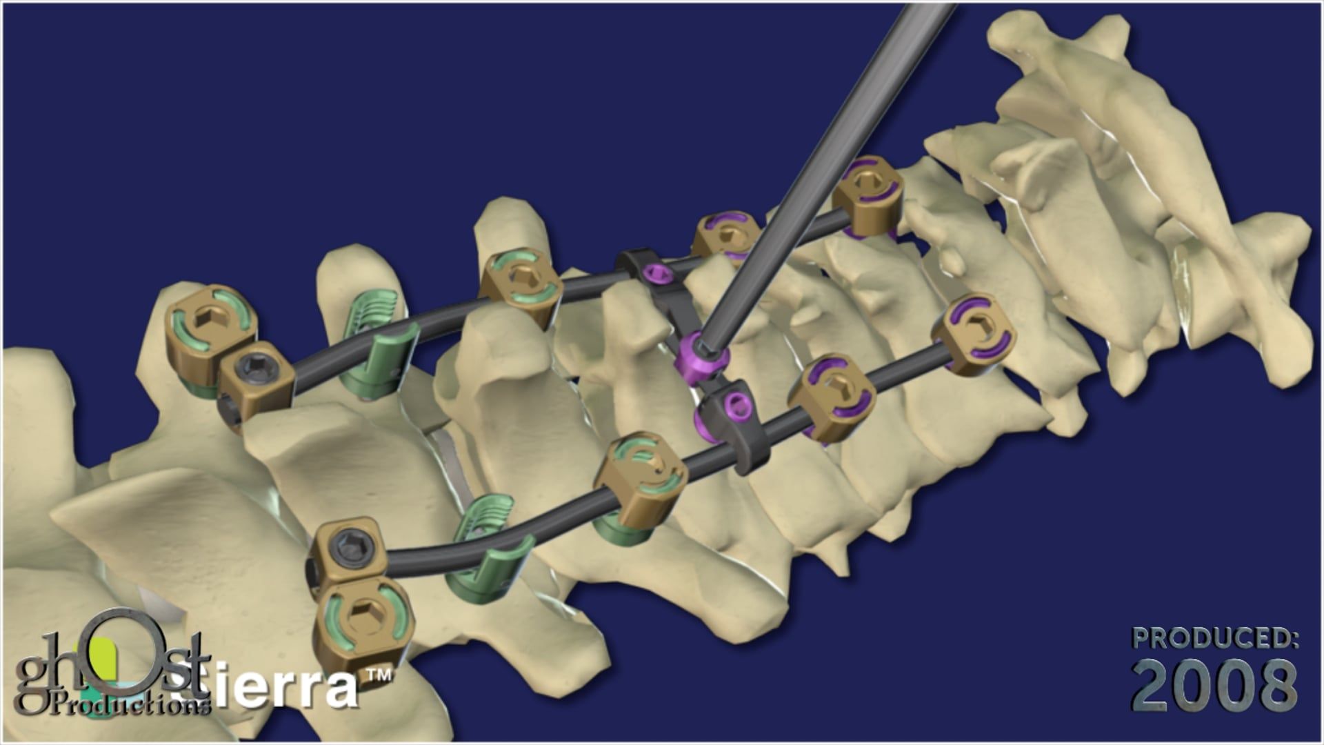 medical animation, Ghost Productions, Sierra system, SeaSpine, occipito-cervico-thoracic system, posterior occipital-cervical, upper thoracic spine, spinal reconstruction, orthopedic surgery, visual representation, medical professionals, patients, valuable tool, detailed, clear.
