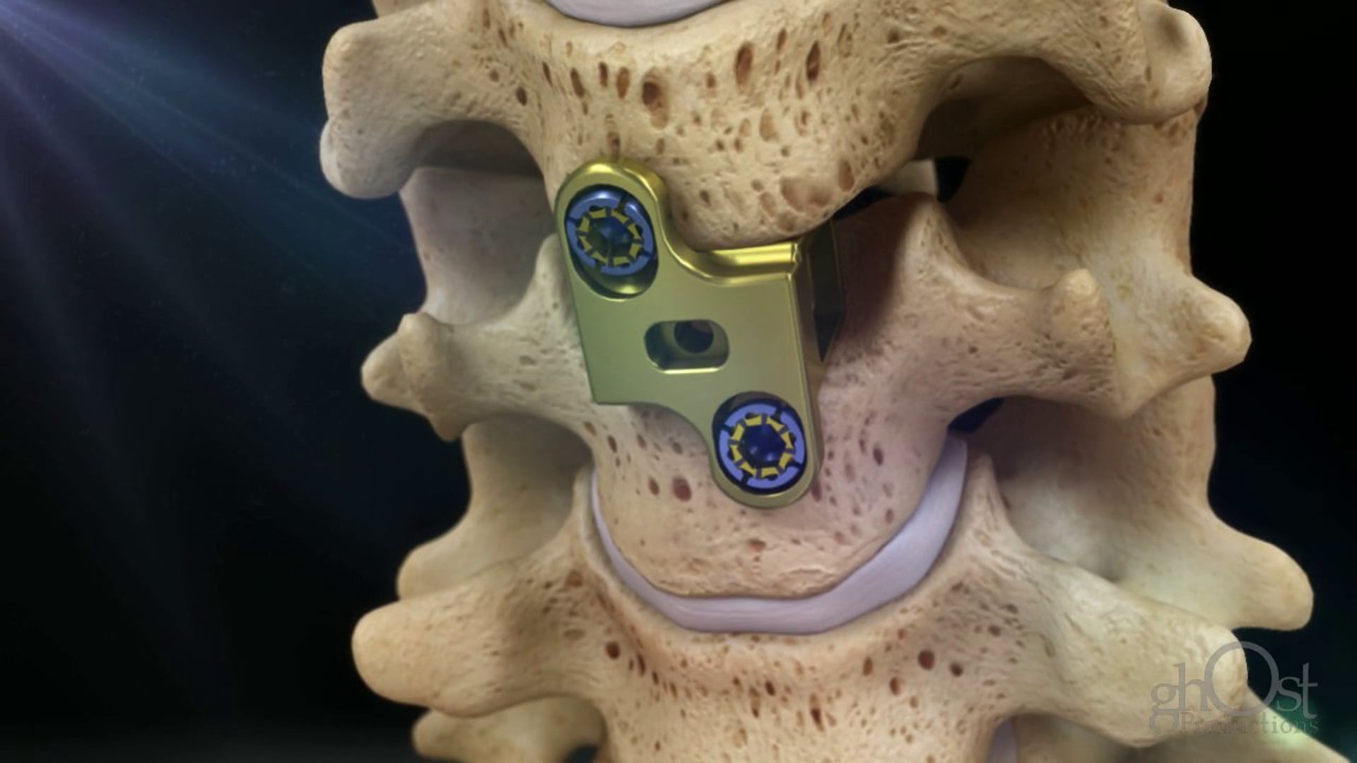 Aesculap, PL-AGE, Anterior Cervical Fusion System, animation, Ghost Productions, surgical technique, unique features, benefits, medical professionals, innovative product, cervical fusion surgery.