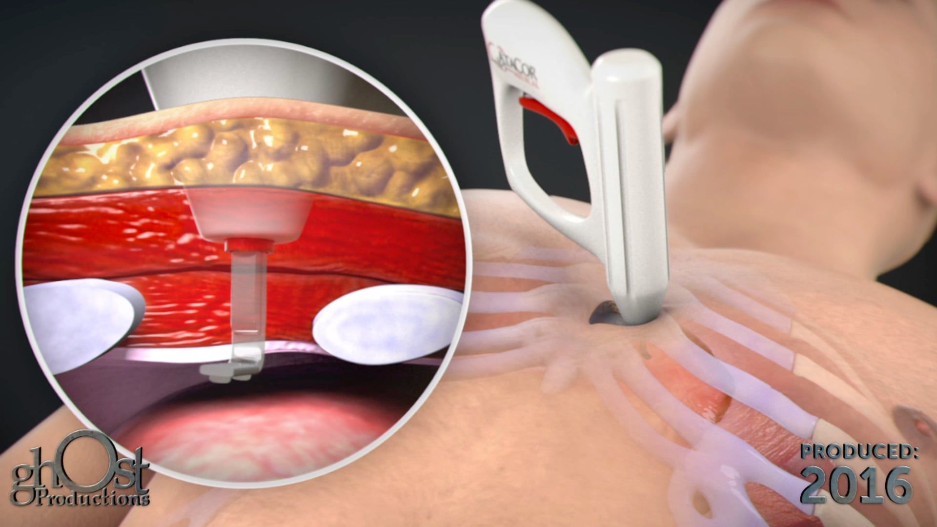 AtaCor, pacemaker device, intercostal access device, lead implantation, remote pacing, medical technology, Ghost Productions, animation, precision, ease, reliable, effective, pacemaker solution, innovative, safe, cutting-edge technology, medical professionals, patients, future of pacemaker technology.