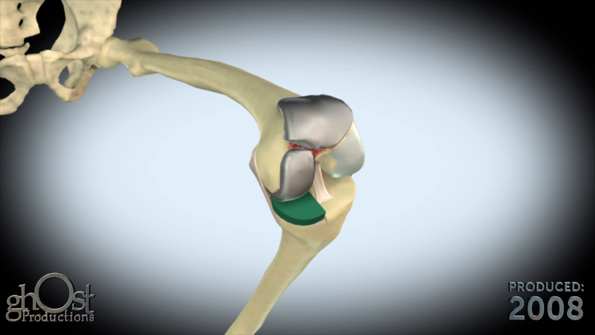 MedCure, Ghost Productions, anatomical specimens, medical research, medical education, knee replacement, surgical procedure, orthopedic surgery, knee joint, medical professionals, medical students, knee replacement technology, high-quality graphics, detailed narration, valuable tool, field of orthopedics.