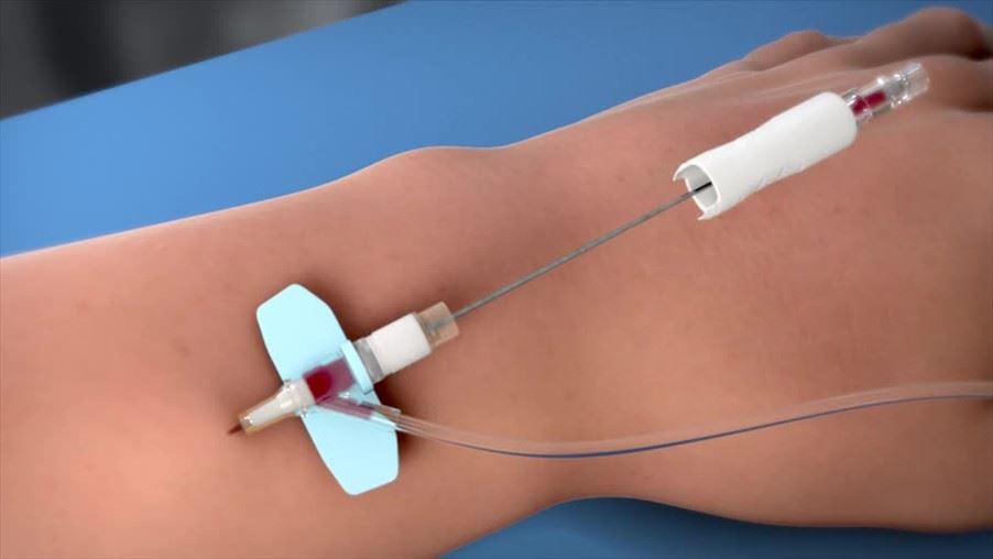 DeltaVen® , Smiths Medical, global medical technology, hemodialysis, Closed System Catheter