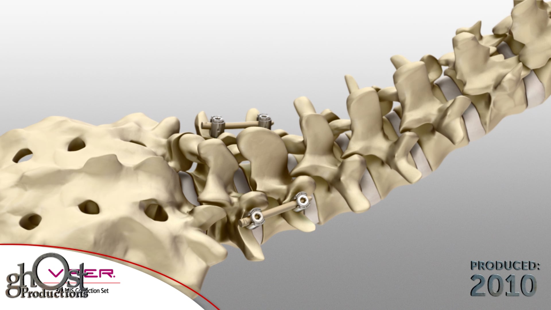 Depuy Spine, Ghost Productions, Viper SC, lumbar fixation system, spinal medicine, medical animation, healthcare professionals, patient outcomes, medical accuracy, innovative device, lumbar spine conditions, unique features, comprehensive understanding, informative resource.