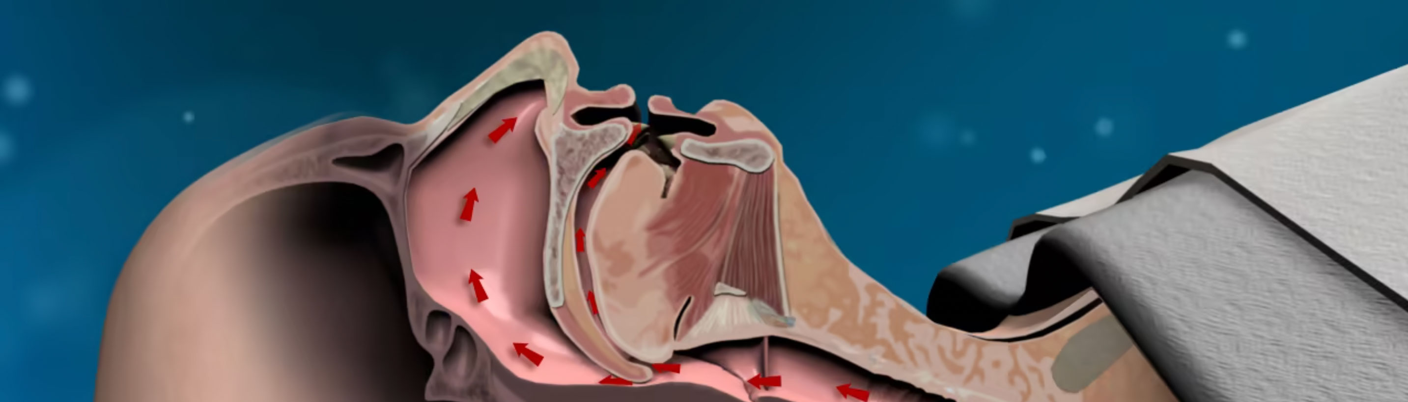 Sleep apnea, Apnex Medical, airflow, animation, medical device, respiratory system, sleep disorders, sleep medicine, pulmonology, otolaryngology, neurology, cardiology, internal medicine, patient education, healthcare professionals.