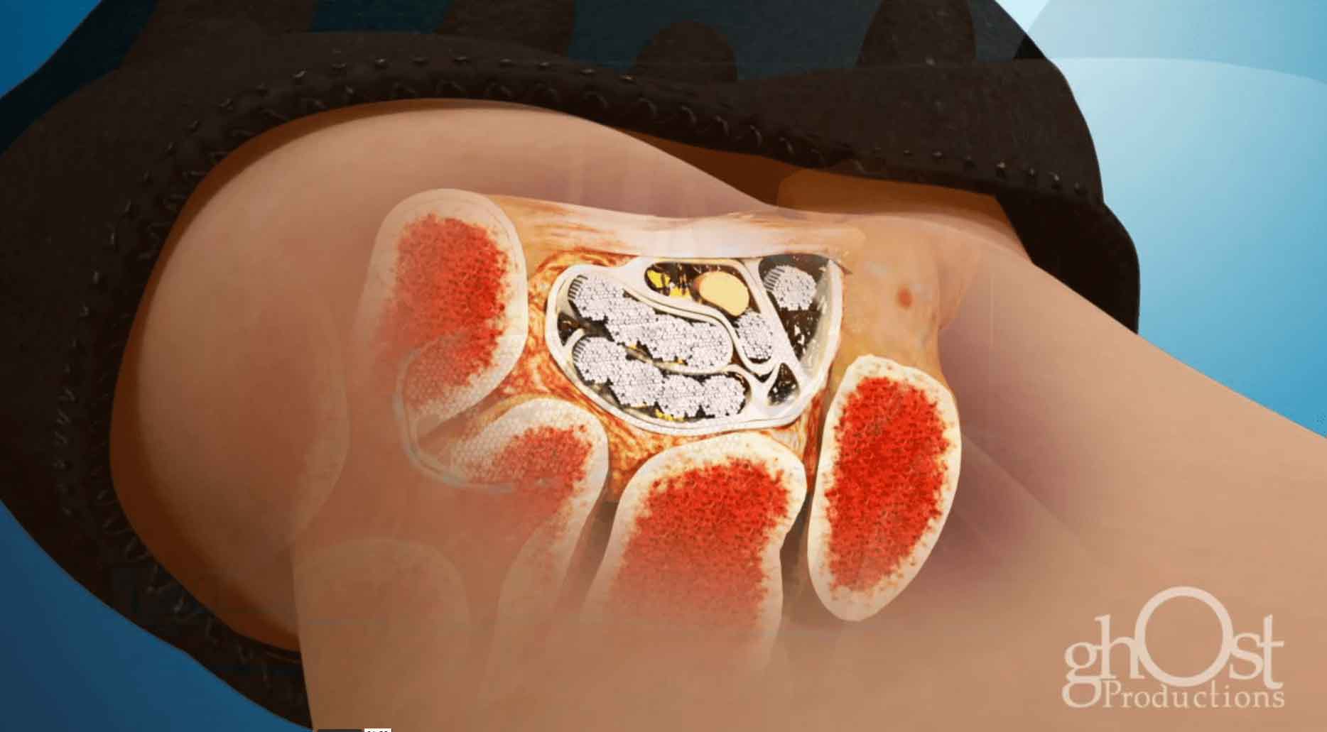 Medical illustration of the Keo Brace, a wrist support designed to alleviate carpal tunnel pain. Made from high-quality, durable, and comfortable materials, it is easy to wear and adjust for a perfect fit on any wrist size. Ideal for daily use to improve quality of life.