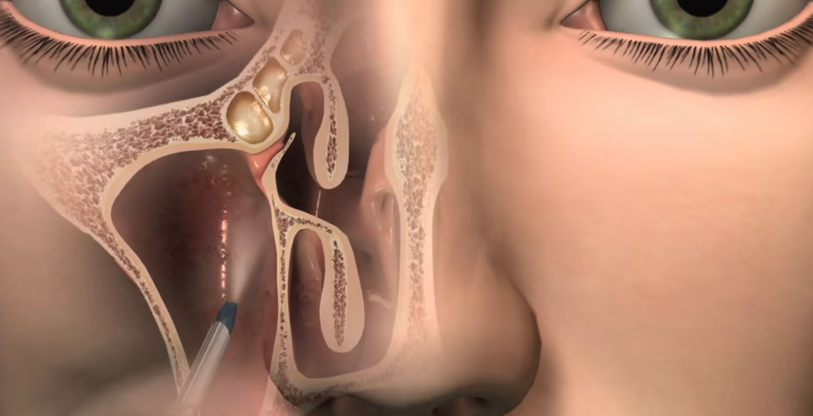 Entellus Medical, FinESS, maxillary sinus dilation, anterior ethmoid sinus dilation, nasal anatomy, sinus issues, in-office procedure, safe and effective, relief from sinus symptoms, advanced technology, non-invasive surgery, ENT, otolaryngology, rhinology, allergist, immunologist, pulmonologist, primary care physician, family medicine.
