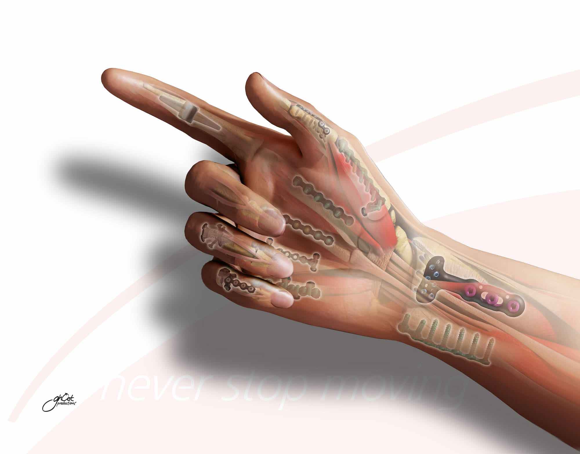 DePuy's medical illustration displays hand injuries and their treatment options, including fractures, dislocations, and tendon injuries. The image provides a comprehensive understanding of hand anatomy and offers valuable information on treatment options like surgery, casting, and physical therapy. A useful resource for patients and healthcare professionals seeking to understand hand trauma.