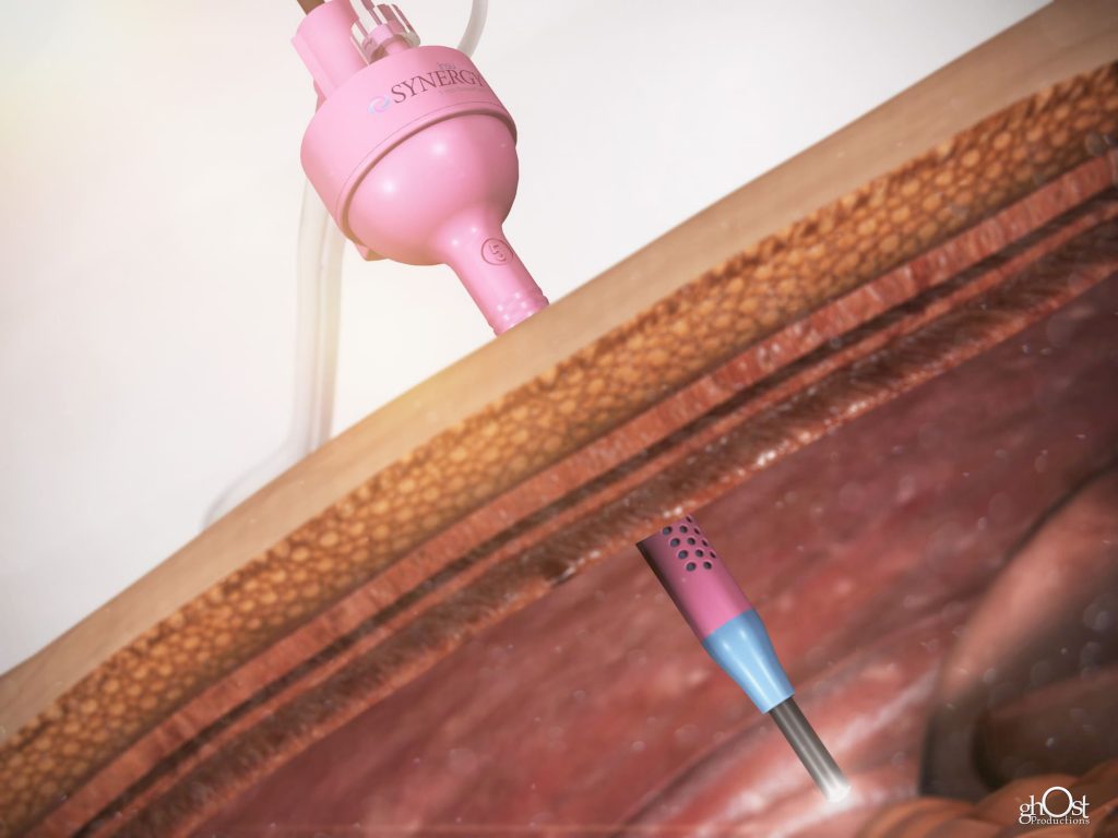 laparoscopic surgery, Synergy Device, Heater and Hydrator Technology, Lexion Medical, Ghost Productions, surgical procedures, precision, efficiency, patient outcomes, surgical technology, medical specialties, laparoscopy, surgery, laparoscopic surgeries, surgical innovation, medical devices, surgical equipment, surgical instruments, surgical tools, surgical technology advancements, medical equipment, medical technology, surgical precision, surgical efficiency, surgical outcomes, laparoscopic surgical procedures, laparoscopic surgical equipment, laparoscopic surgical instruments, laparoscopic surgical tools, laparoscopic surgical technology, surgical advancements, surgical devices, surgical innovations, surgical technology advancements, medical advancements.