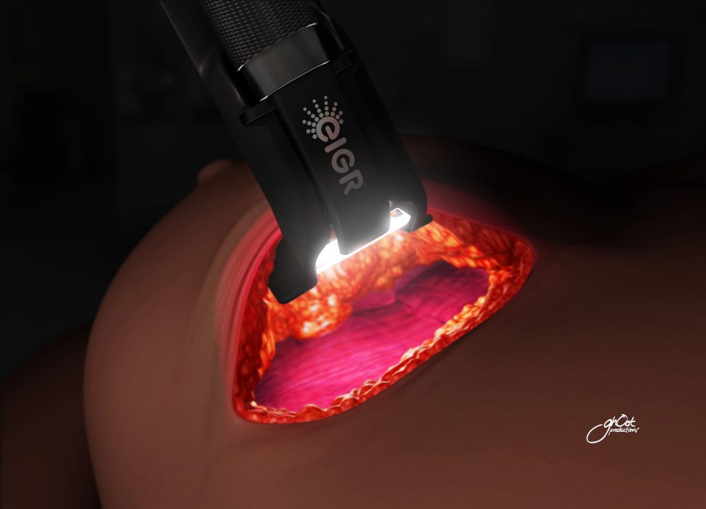 Medical animation showing Invuity's EIGR technology. Highlights surgical locations and benefits of the technology. Created by Ghost Productions.