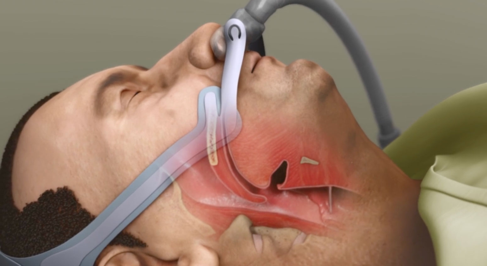 sleep apnea, CPAP mask, Mayo Clinic, animated guide, benefits, pathology, breathing, symptoms, overall health, treatment options, medical specialties: pulmonology, sleep medicine, otolaryngology, neurology, internal medicine, family medicine.