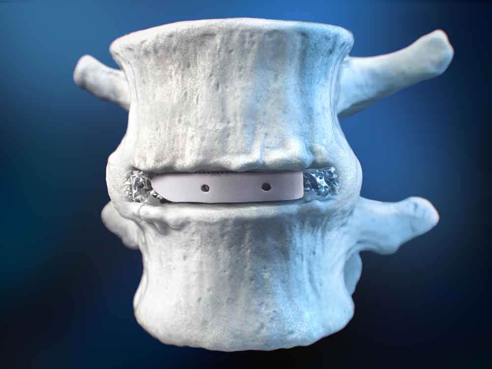 Spinal Device Technology, Invibio PEEK-Optima HA, osteoconductive support, hydroxyapatite, PEEK-OPTIMATM matrix, spinal conditions, improved quality of life, osteoconductive material, unparalleled support, medical specialties: orthopedics, neurosurgery, spinal surgery, physical therapy, rehabilitation, pain management, chiropractic care.