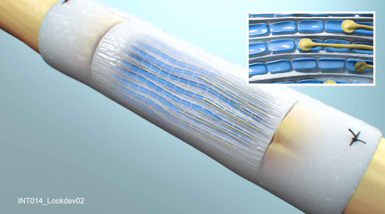 Animation showing the NeuraGen Nerve Guide, a resorbable implant for repairing peripheral nerve discontinuities. It creates a protective environment for nerve repair, acting as a conduit for axonal growth across a nerve gap. Produced for Integra Life Sciences.