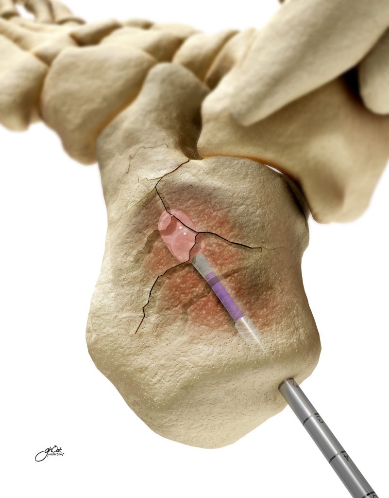 Medtronic, KyphonReel, Fracture Management System, healthcare professionals, fractures, animation, Ghost Productions, medical professionals, patients, cutting-edge technology, visually engaging, expert animation skills, medical specialties, orthopedics, neurology, radiology, emergency medicine, sports medicine, physical therapy, rehabilitation, pain management, surgery, musculoskeletal disorders.