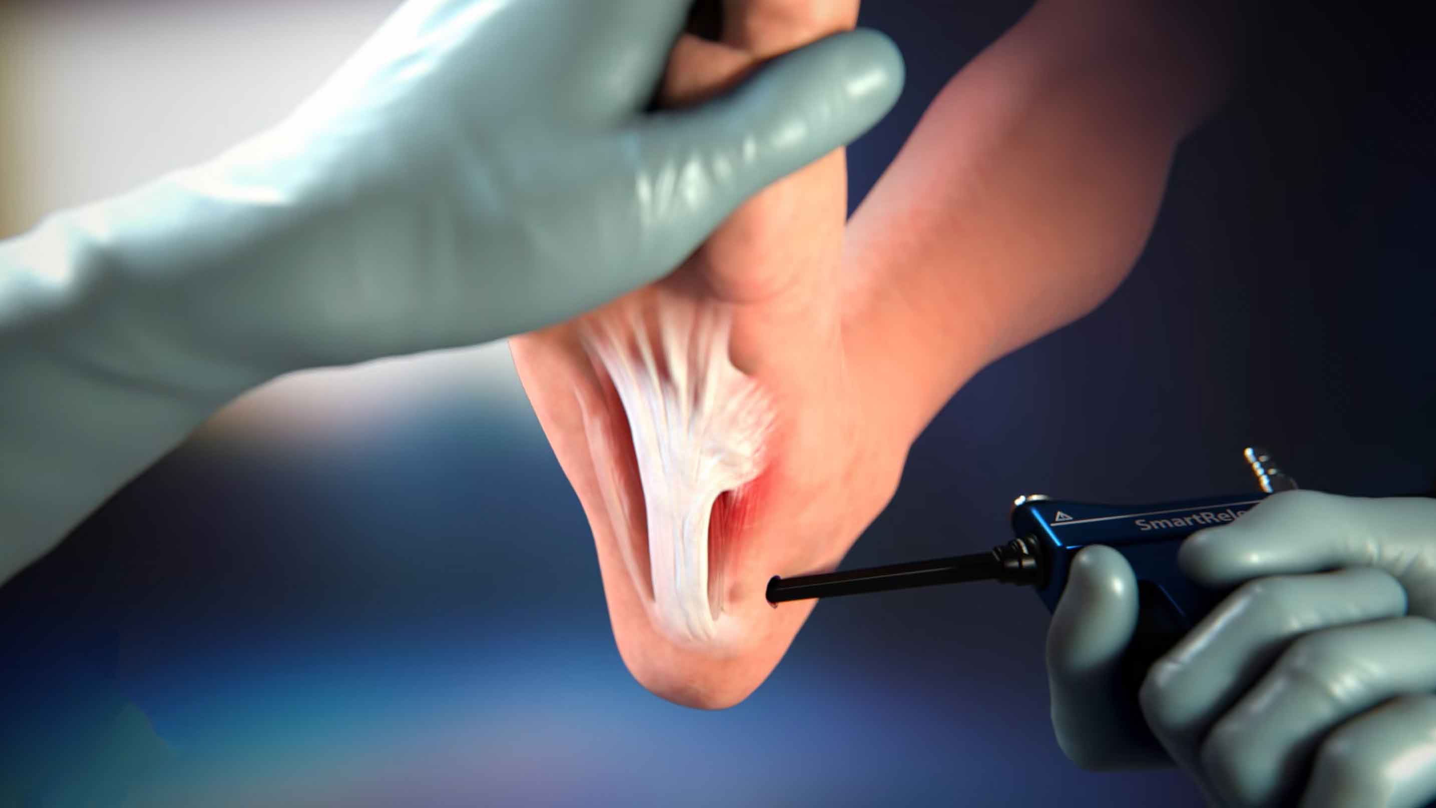 The MicroAire SmartRelease System is a solution for foot pain relief. It involves cutting part of the plantar fascia ligament to relieve tension and inflammation. The system comprises an endoscope and a handpiece that holds an elongated, disposable blade assembly, which connects to any standard video camera and light source. The surgeon introduces the blade assembly into the carpal tunnel through a limited incision in the wrist flexor crease, providing a minimally invasive and effective solution for foot pain relief.