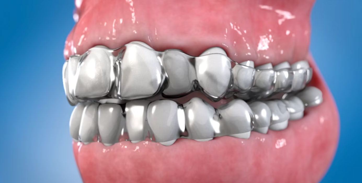 ClearAligners, Patterson Dental, orthodontic treatment, alternative to traditional braces, customized process, patient assessment, clear aligners, medical animation, discreet orthodontic solution, Future of Orthodontic Treatment, expert narration, medical marketing retainer, comfortable aligners, orthodontic practitioners, dental specialists, dental professionals, dental technology, dental innovation.