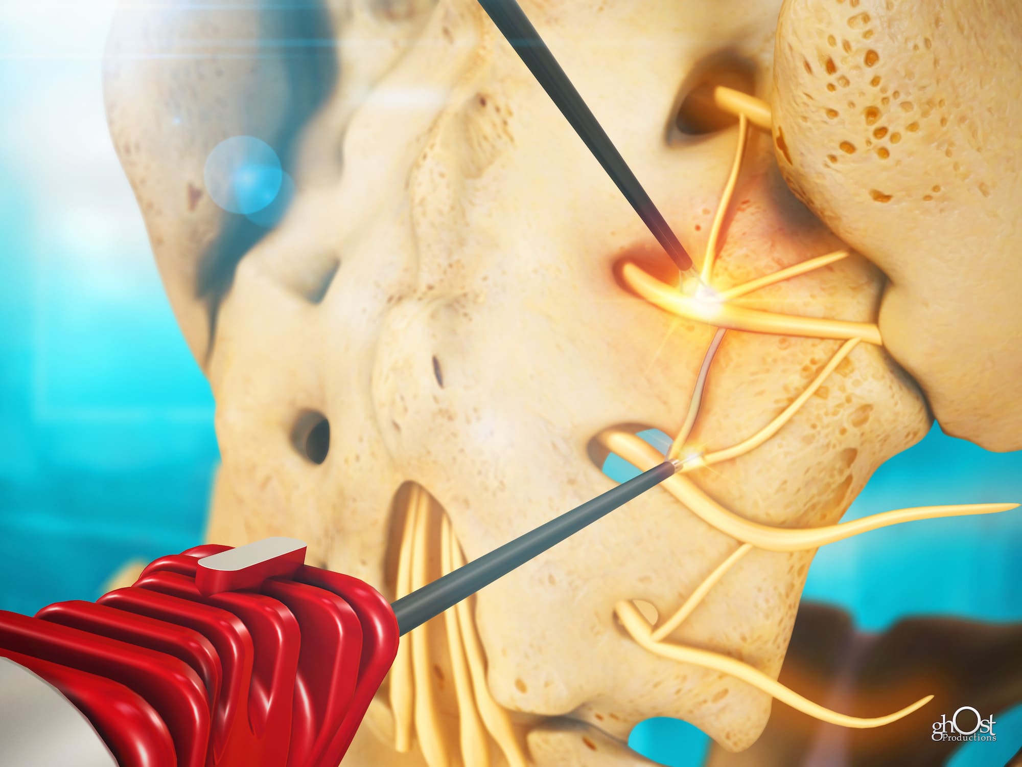 Illustration of NimbusRF Electrode, a medical device by Nimbus Concepts that helps alleviate patient pain during radiofrequency thermal neurotomy procedures. Ghost Productions created an animation to showcase its innovative design and functionality. Advanced technology makes this electrode a must-have for medical professionals seeking to provide patients with the best care and comfort.