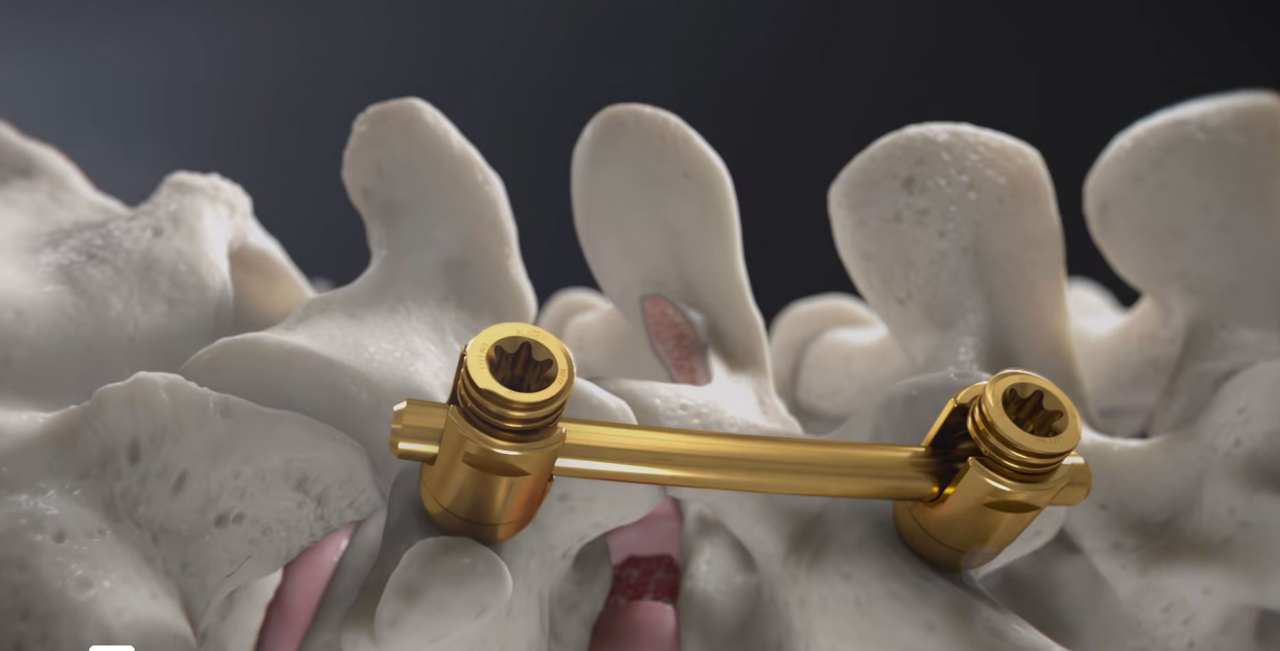 Illustration of the Modera Pedicle Screw System from New Era Orthopaedics, a solution for stabilizing the thoracolumbar spine. The system includes a range of pedicle screws in different diameters and lengths, with options for straight or pre-lordosed rods, as well as cannulated or non-cannulated screws. Surgeons can easily and quickly secure the assembly with this innovative system, making it a game-changer for orthopaedic surgery.