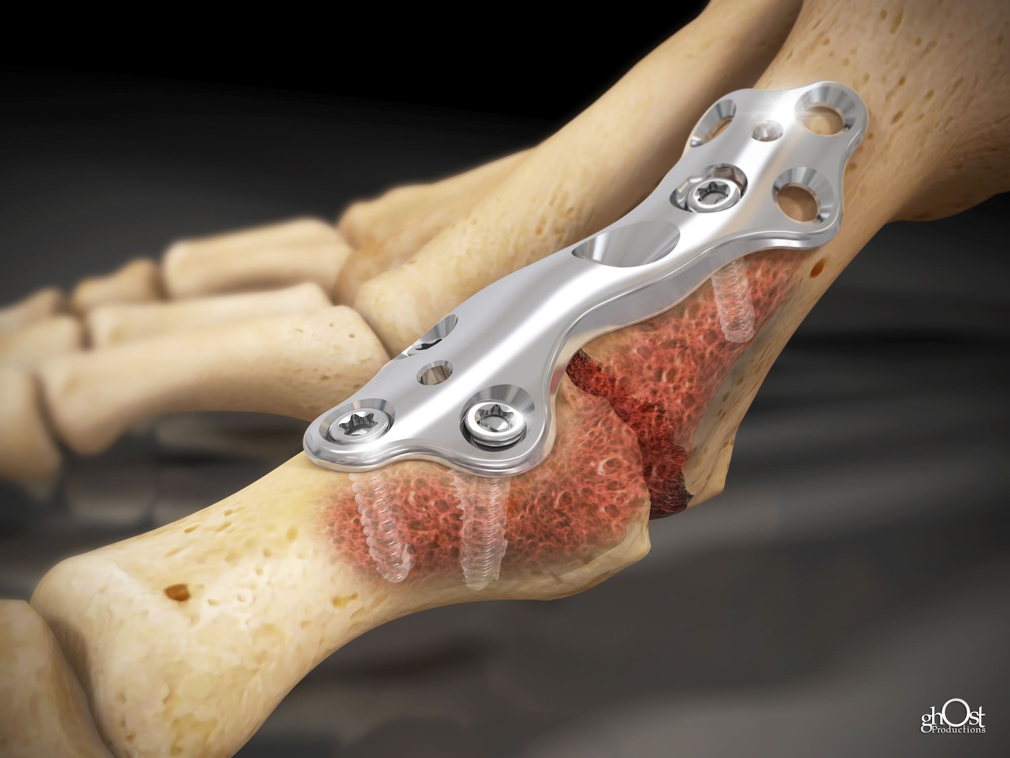 OsteoMed, Footplate Device, foot fractures, foot pathologies, medical animation, Ghost Productions, small plate solutions, non-locking, angled locking, cannulated lag screws, surgical precision, stability, advanced features, innovative technology, medical professionals