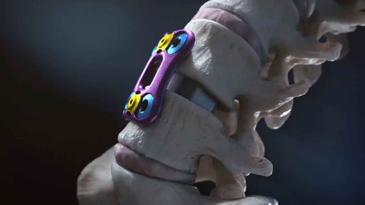 Revolutionary spinal implant medical device for improved mobility and pain relief. Expertly crafted for maximum support and stability, reducing pain and increasing mobility. Designed to help individuals suffering from spinal conditions regain quality of life and enjoy a more active lifestyle. Trust in our device for relief and a fuller life.