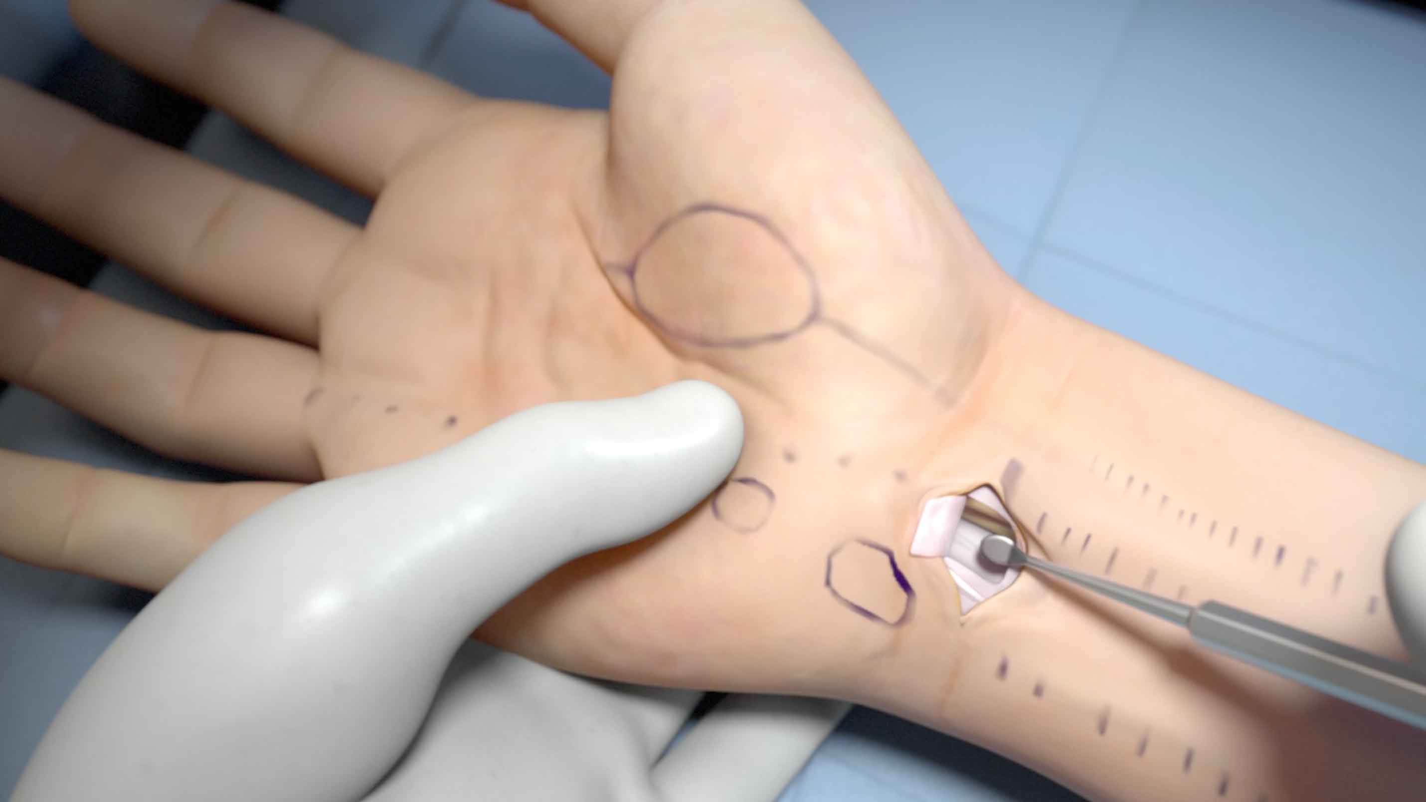 Medical Animation of a carpal tunnel hand